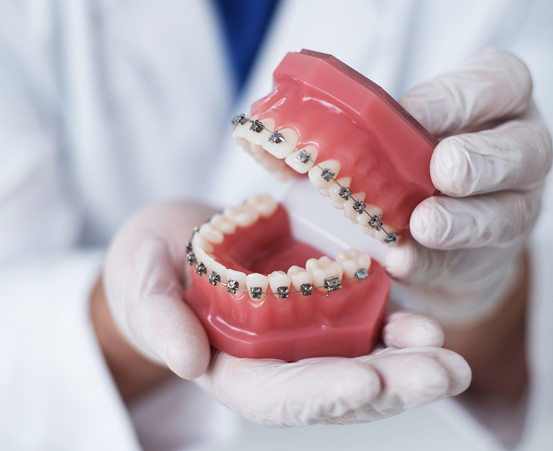 Какие виды брекетов существуют?